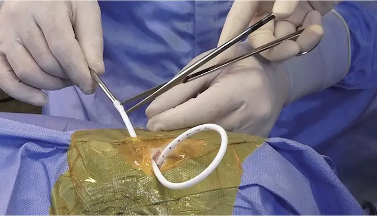 HEMORRHAGIC ICP CATHETER